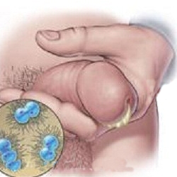 gonorrea